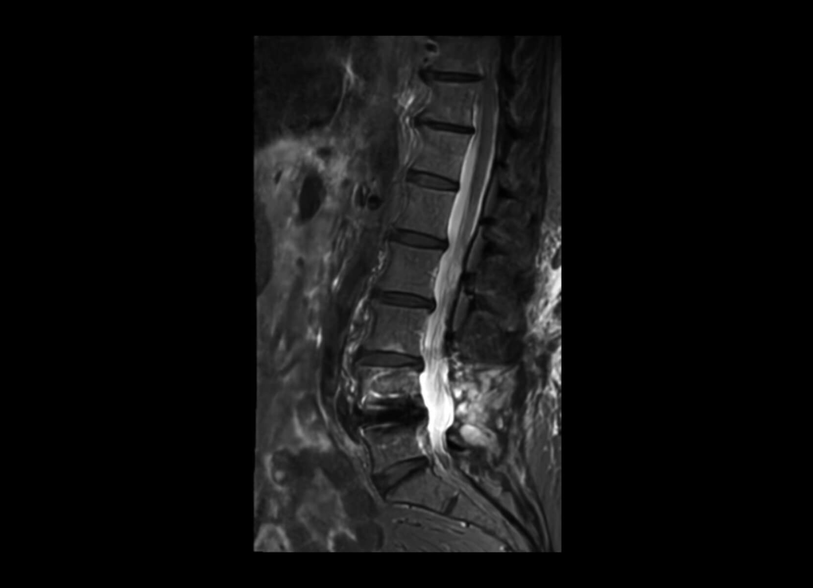Trauma + Metal Implant 3T Philips Achieva - After