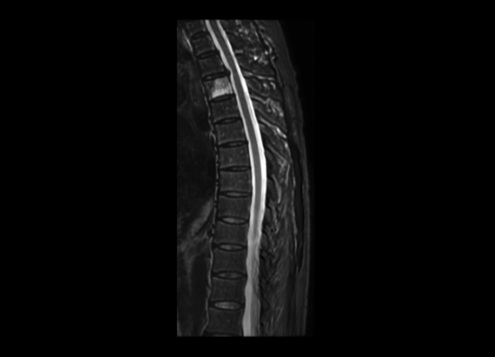 Non-cord Lesion GE 3T Discovery MR750 - After