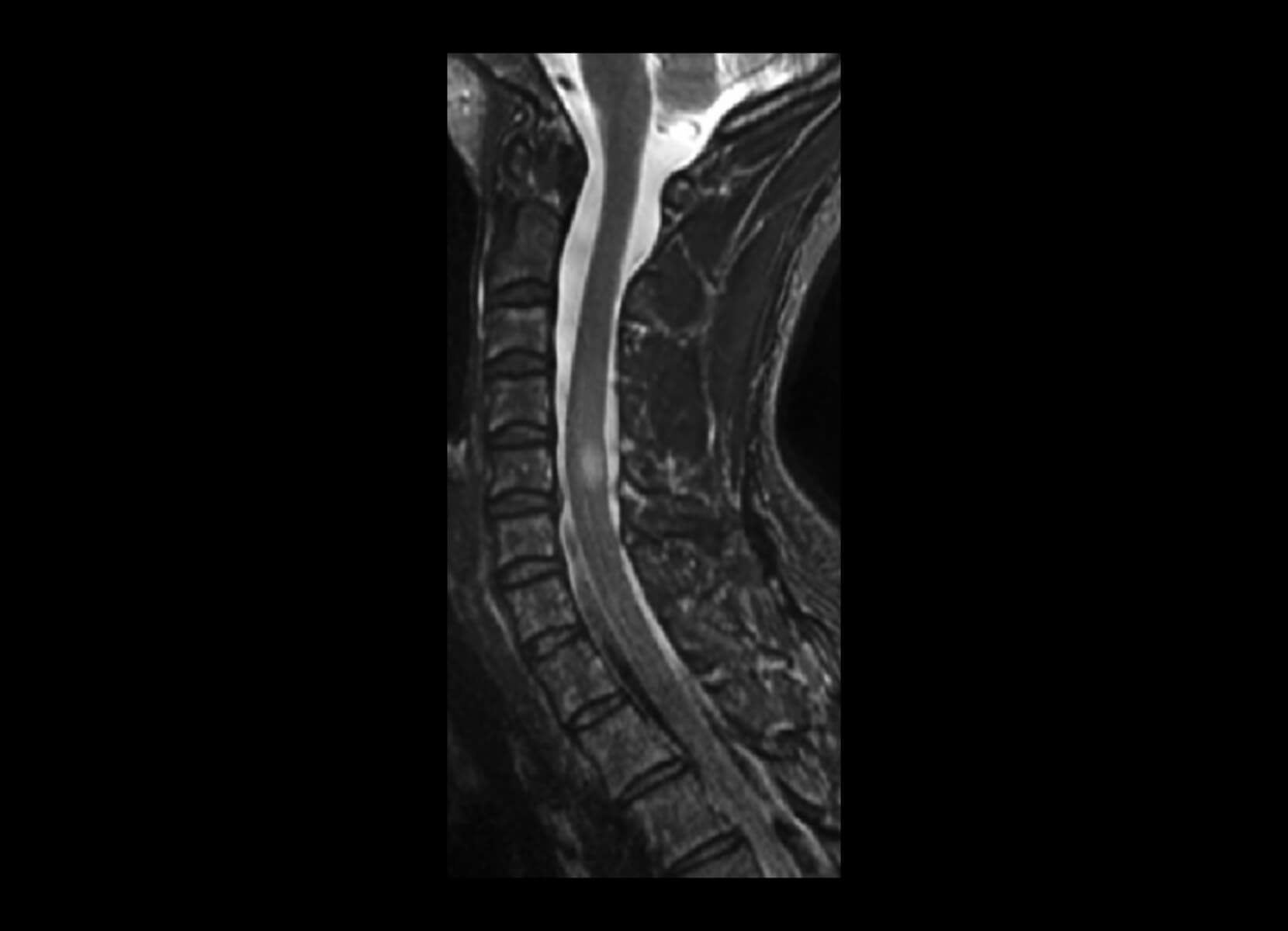 Cord Lesion GE 3T Discovery MR750 - After