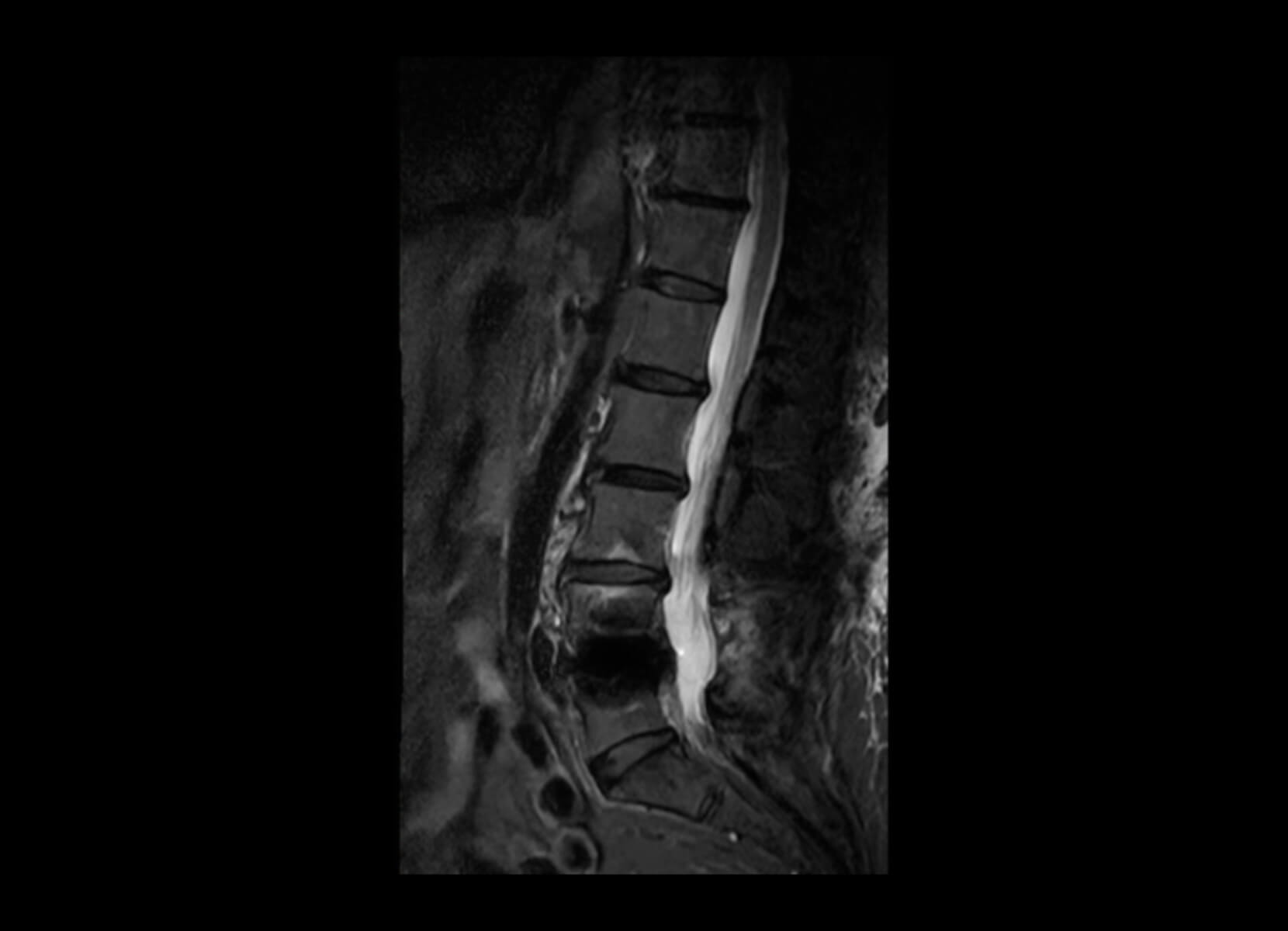 Trauma + Metal Implant 3T Philips Achieva - Before