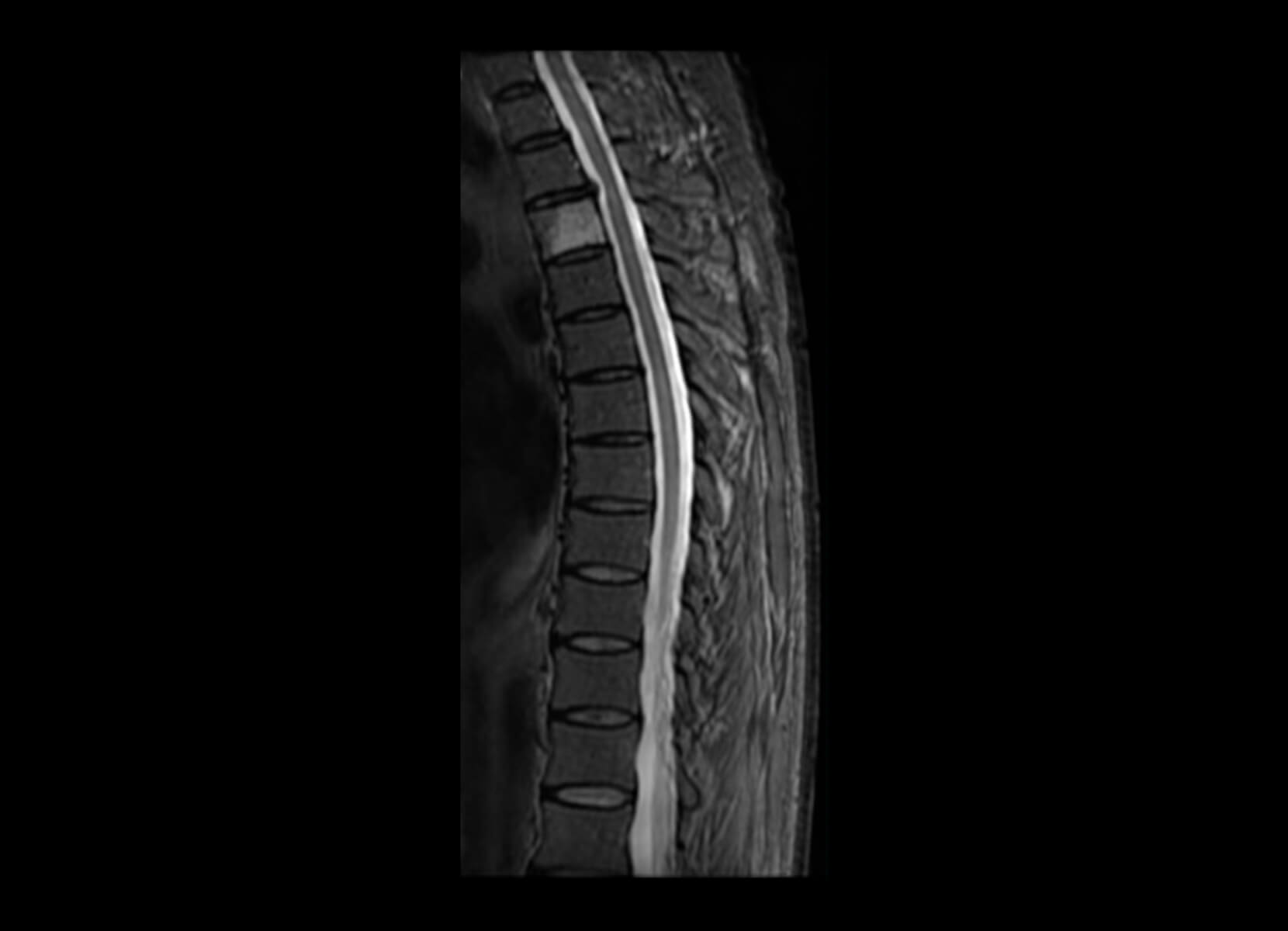 Non-cord Lesion GE 3T Discovery MR750 - Before
