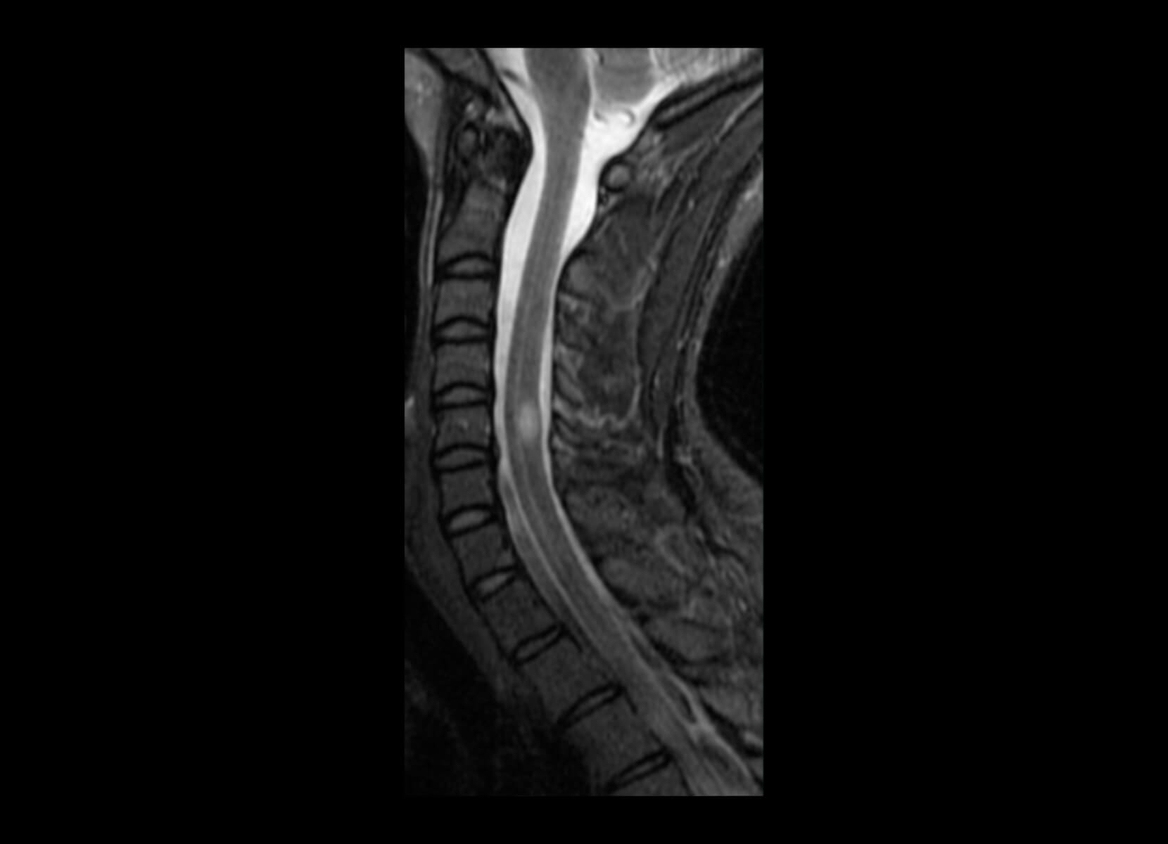 Cord Lesion GE 3T Discovery MR750 - Before